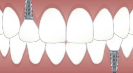השתלת שיניים ביום אחד – מה חשוב לדעת על התהליך?