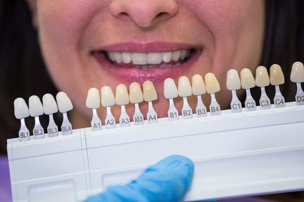 ציפויי שיניים בטורקיה
